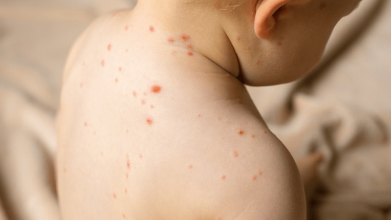 Sarampión en México