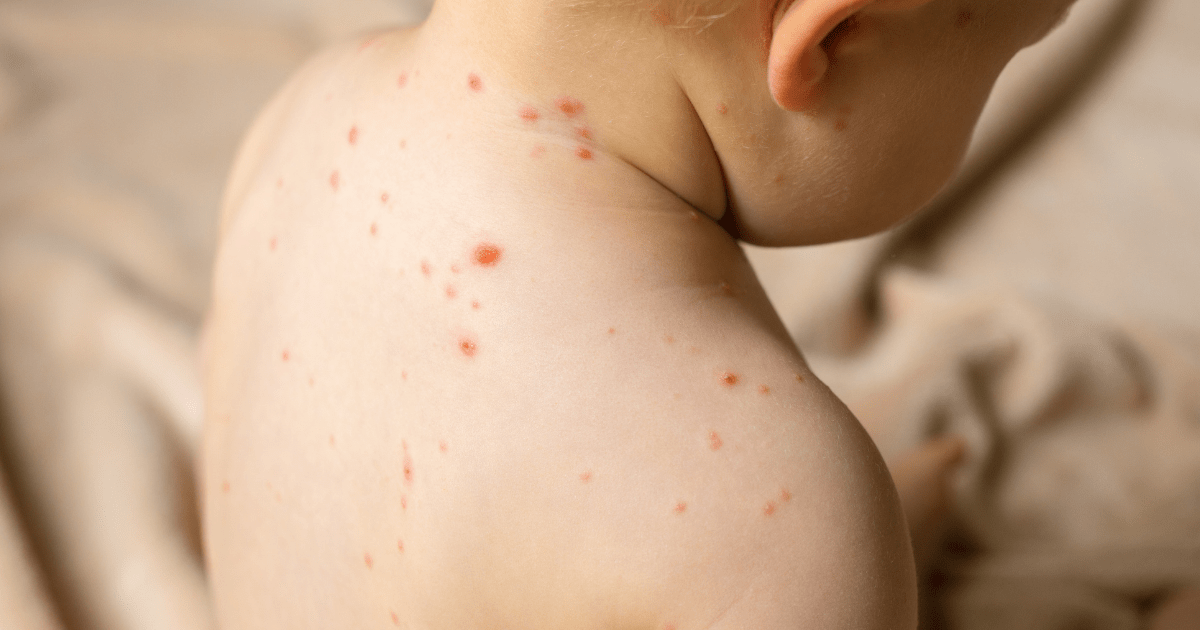 Sarampión en México